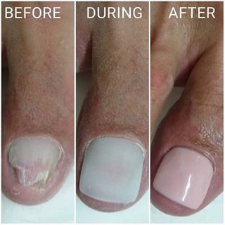 Cosmetic Podiatry / Nail Reconstruction
